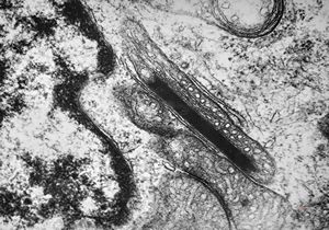 M,12y. | germinoma - intramitochondrial lamellar formation